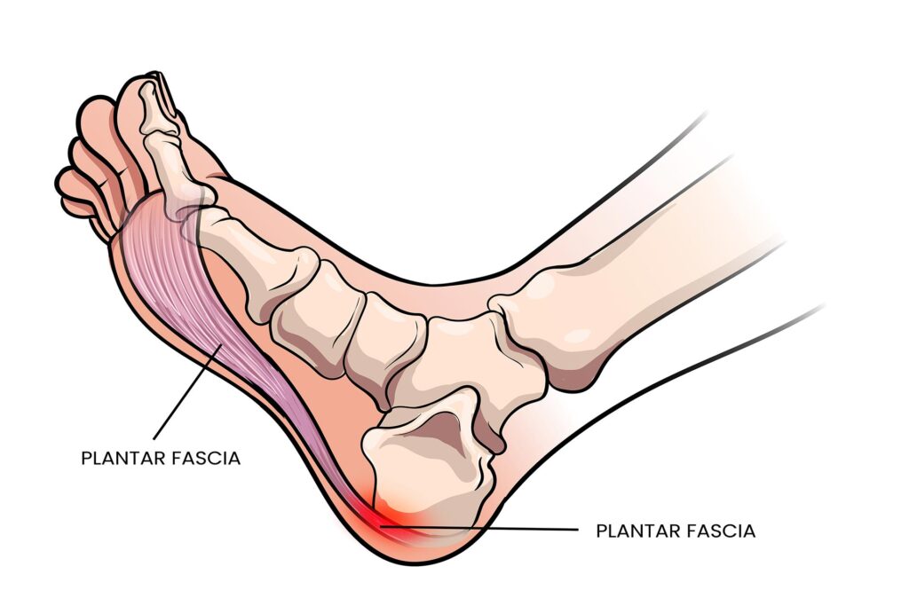 Diagram of Plantar fasciitis